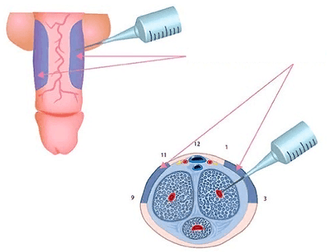 injecties om de penis dikker te maken